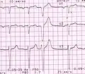 Premature ventricular complexes or Extrasystoles