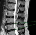 IRM lombaire sagittale montrant des protrusions discales.