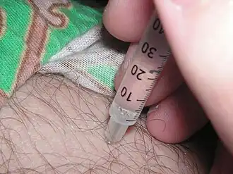 Image rapprochée montrant une seringue médicale dont l'aiguille est enfoncée dans la peau d'un patient. Le niveau du produit contenu est gradué à 20.