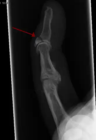 Radiographie montrant une fracture à l'insertion du tendon extenseur