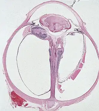 Description de l'image Persistent hyperplastic primary vitreous.jpg.
