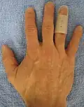 Un exemple d'attelle pour doigt en maillet.