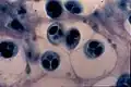 Microphotographie des changements histologiques causés par une infection du cartilage d'un saumon par Myxobolus cerebralis (Myxozoa)