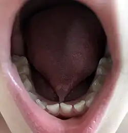 Ankyloglossie antérieure (enfant de 4 ans).