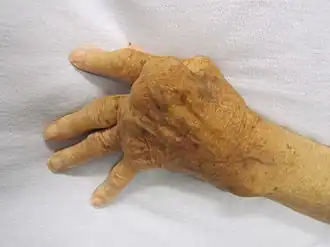 Typische Ulnardeviation bei rheumatoider Arthritis