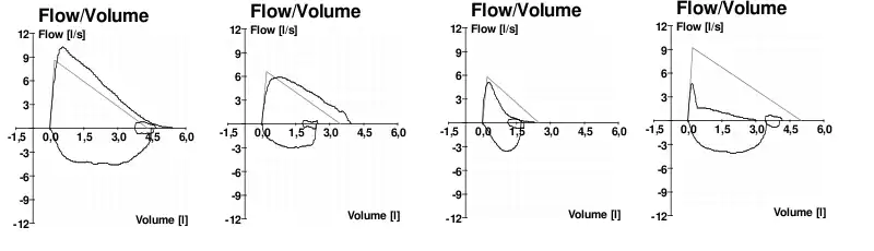 Typische Fluss-Volumen-Diagramme bei (v.&nbsp;l.&nbsp;n.&nbsp;r.) normaler Atmung, fehlender Mitarbeit des Patienten, Asthma, und COPD
